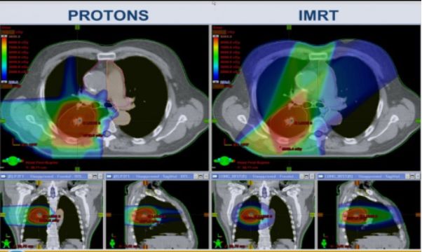 一表总览！迄今为止最全的肿瘤质子治疗适应症盘点！（收藏备用）