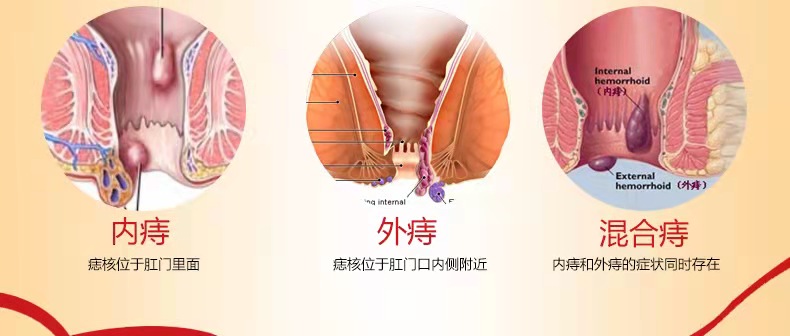 盘点引发痔疮的4大习惯,四个坏习惯容易得痔疮看看你有吗