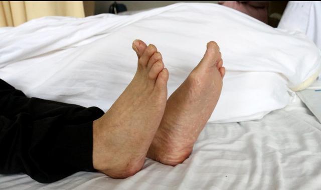 骨折了一定要注意安全,骨折下地过早引起骨不连怎么办