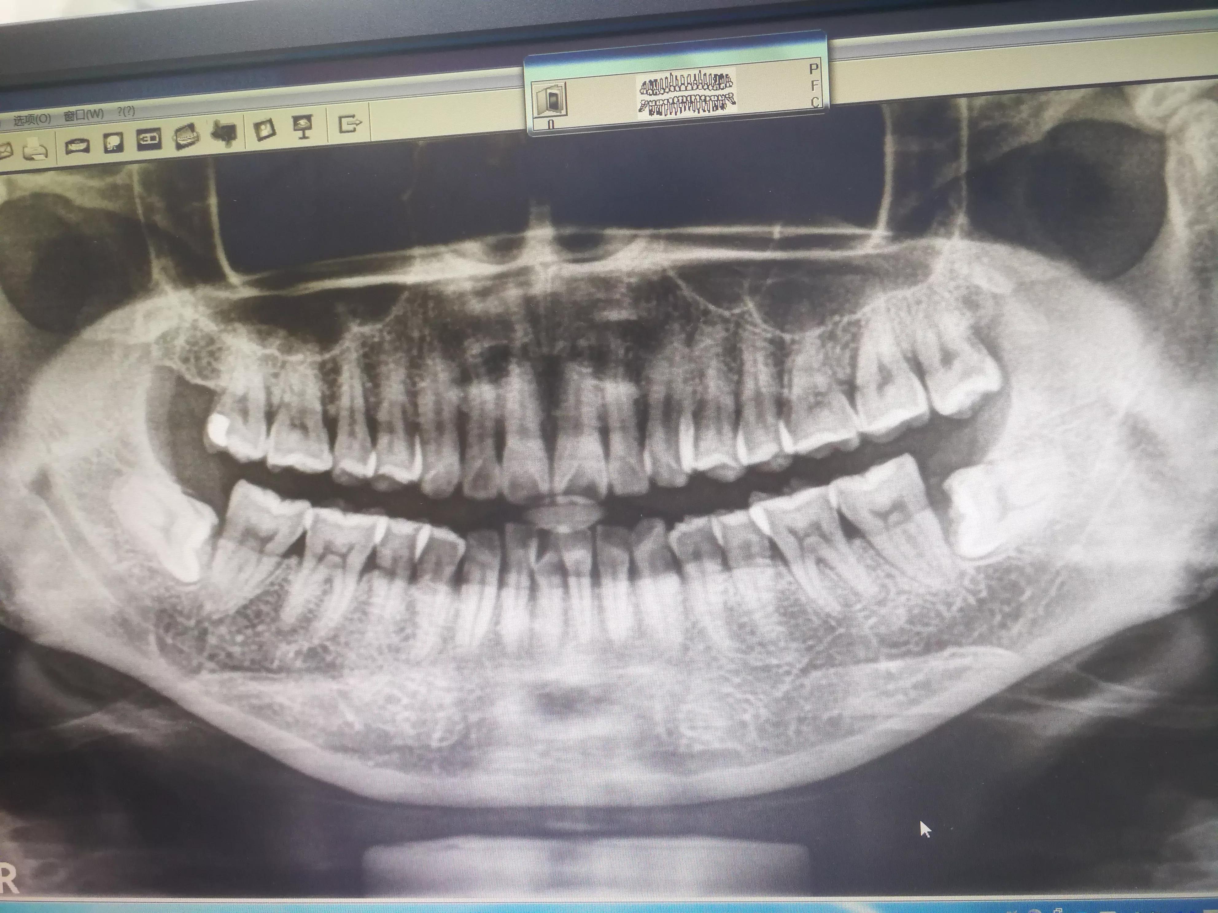 拔歪牙的过程,拔一颗长歪的牙