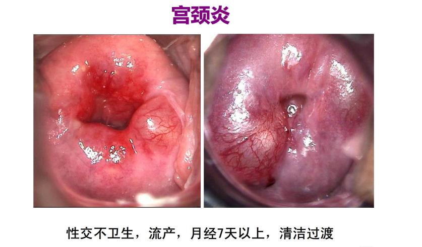 男性得hpv高危与低危的区别,男女患hpv的概率一样吗
