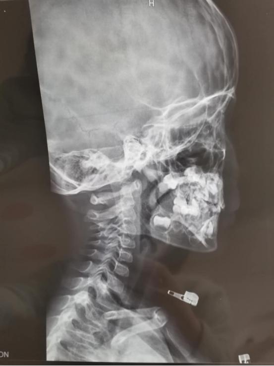 一直鼻塞呼吸不畅侧身睡就通气,呼吸困难痰多鼻塞怎么治疗