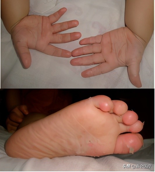 手足口病诊疗指南及解读,手足口病知识普及