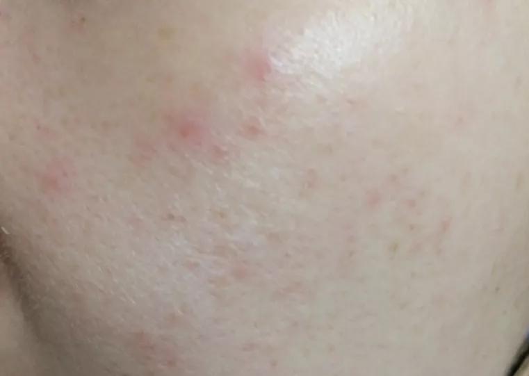 敏感干燥起皮泛红怎么修复,泛红起皮有刺痛感如何护肤