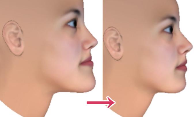 骨性龅牙怎么弄,如何判断骨性龅牙的轻重程度