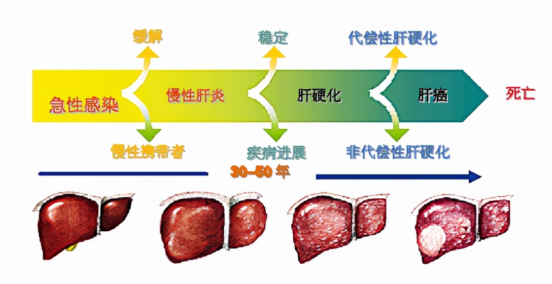 肝硬化症状,肝硬化药