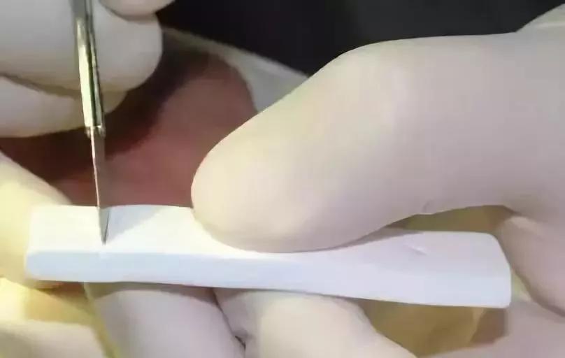 膨体材料真的很难取吗,膨体怎么取出来