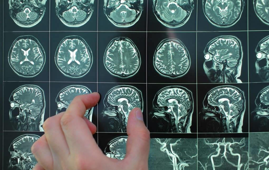 发现脑梗和腔梗怎么治疗,出现腔梗前兆怎么办