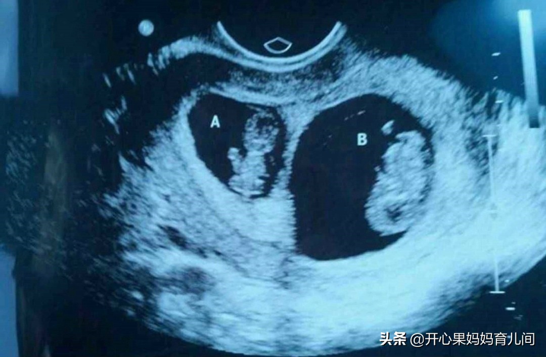 一代试管孕30周查出胎儿畸形,试管双胞胎孩子畸形