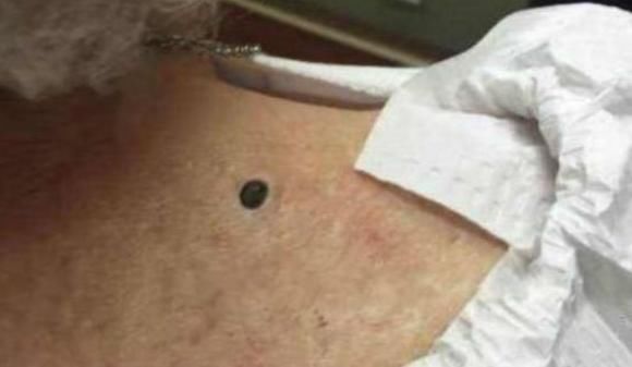 女人背后长了好多红色的痣,女子背上长的老黑痣最近痛痒