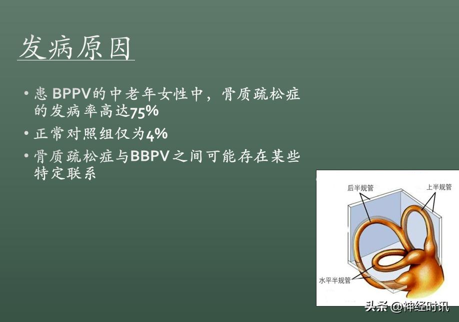 良性位置性眩晕诊断和治疗指南,良性阵发性位置性眩晕的诊断标准