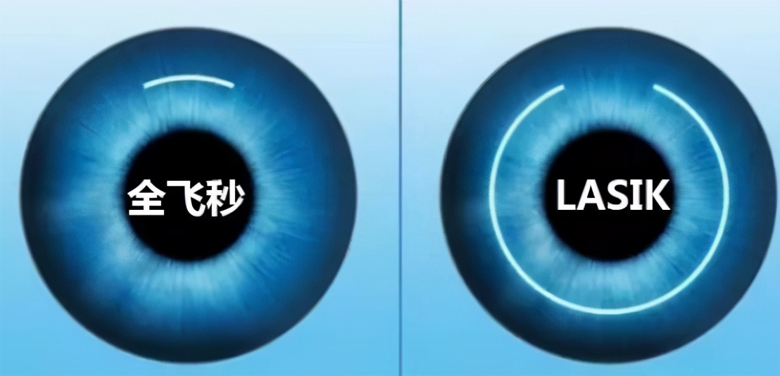 目前控制近视度数有哪些方法,角膜塑形镜停戴后近视度数飞涨