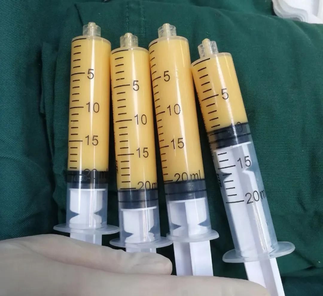 自体脂肪填充全脸逆袭,自体脂肪填充的真相来了