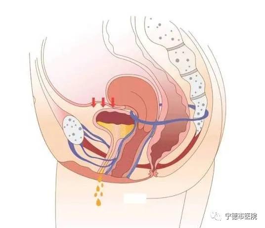 「患者福音」宁德师范学院附属宁德市医院盆底中心招募尿*禁失**患者