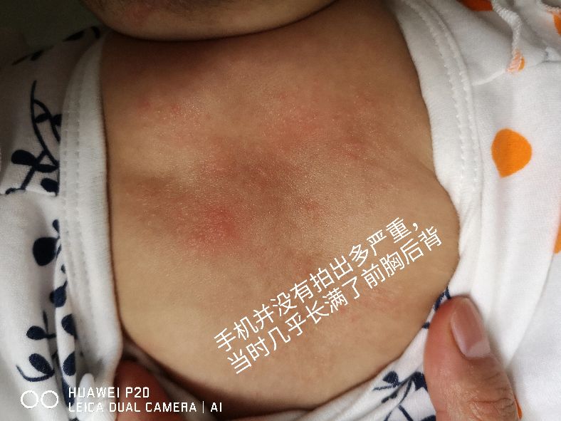 家有湿疹娃是什么体验,家有宝宝必会急救知识