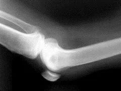 肋骨骨折怎么加速恢复,骨折如何加速恢复