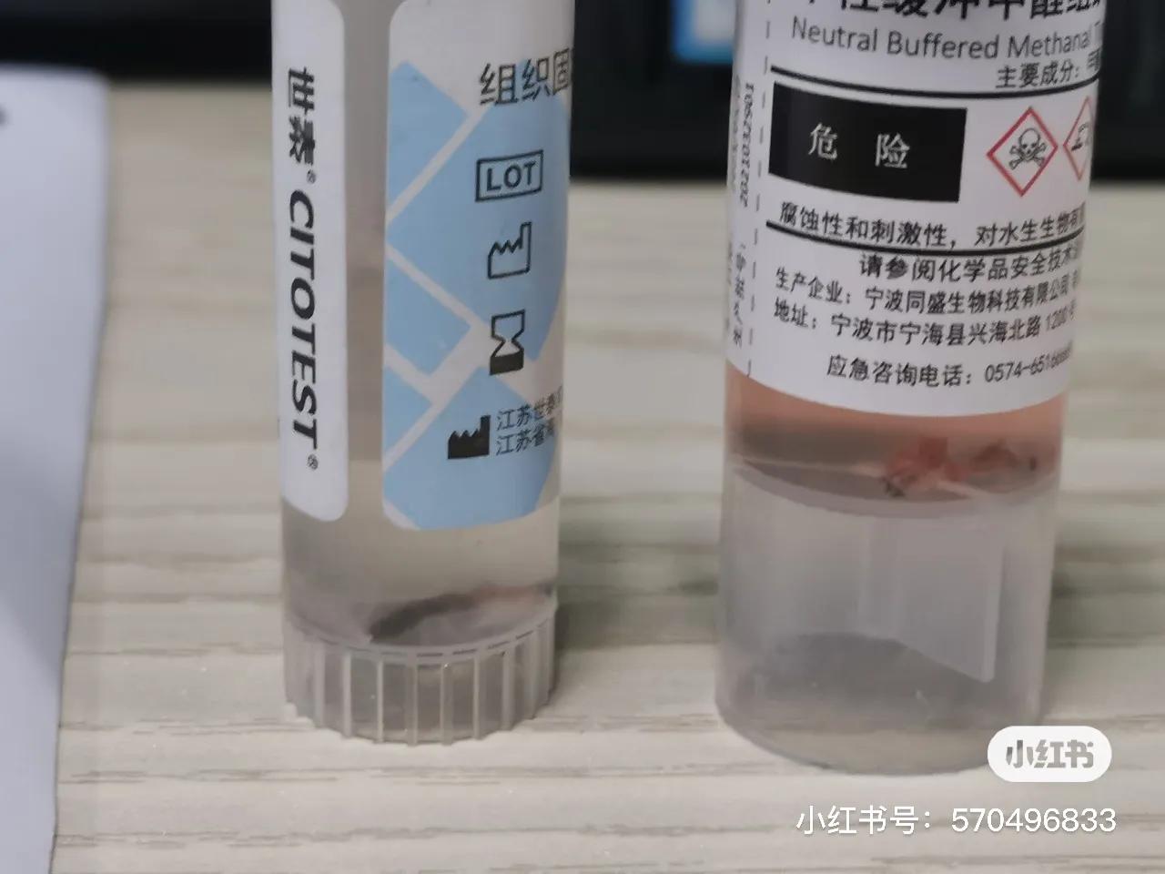 一个冷冻针救治89岁肺癌脑转移病人后续