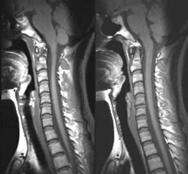 喉部病变做核磁还是ct,耳鼻喉科常见病影像诊断