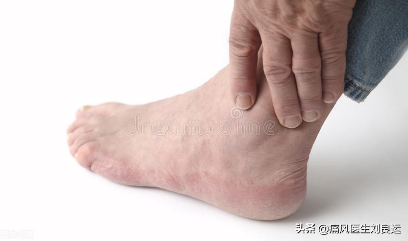 痛风会在脚趾和膝关节同时发作吗,痛风发作从脚趾头到脚踝又到膝盖
