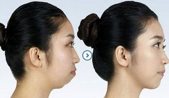 下巴丑如何解决,下巴长得丑怎么用自然方法改善