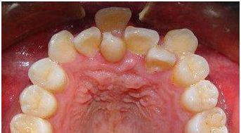 孩子牙齿不齐需要矫正吗,孩子牙齿不齐矫正有必要吗