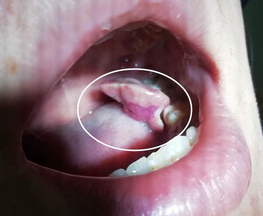 孕妈妈牙龈出血是因为贫血吗,孕妈妈牙龈出血