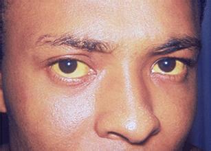 干扰素抗病毒的优缺点，你知道多少？