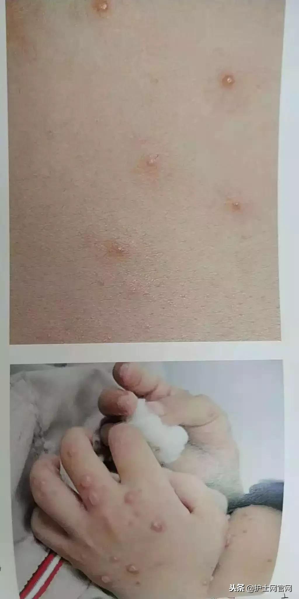 水痘患者怎么隔离,水痘病人病室挂什么隔离