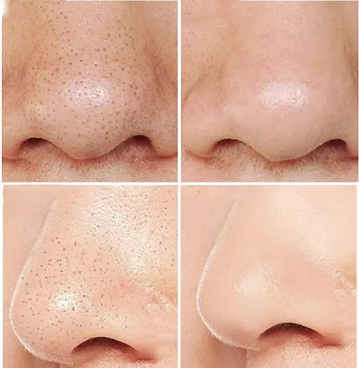 赵丽颖皮肤毛孔粗大图片,赵丽颖无美颜无滤镜最真实的模样