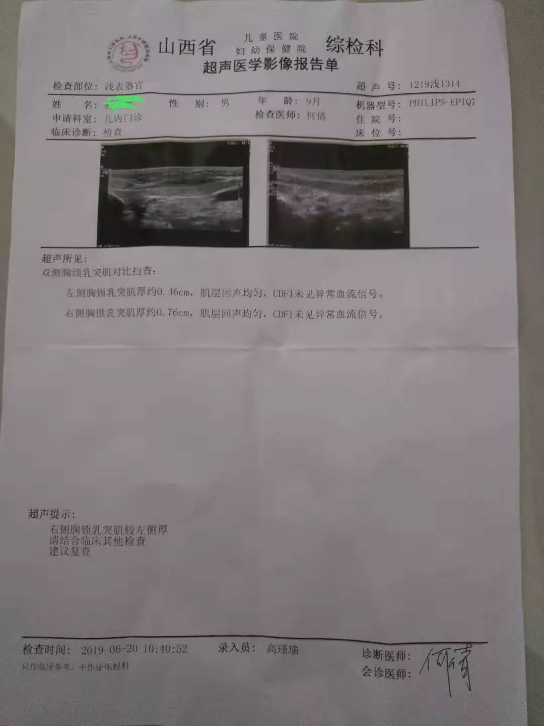 小儿肌性斜颈表现及治疗方案,婴儿肌性斜颈肿块多大算严重