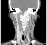 放疗不独用于癌症，治疗良性病也有奇效