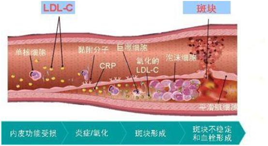 血管内的斑块如何吃药能根治,血管里面的斑块中药如何去除