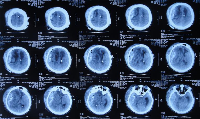 开颅手术后颅内细菌感染图片,外伤开颅手术后脑积液能恢复吗