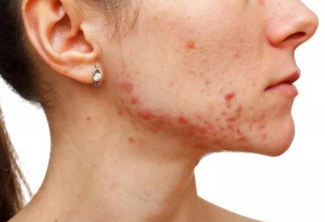 脸上痘印多久会自行消失,在脸上挤痘痘留下的痘印会消失吗