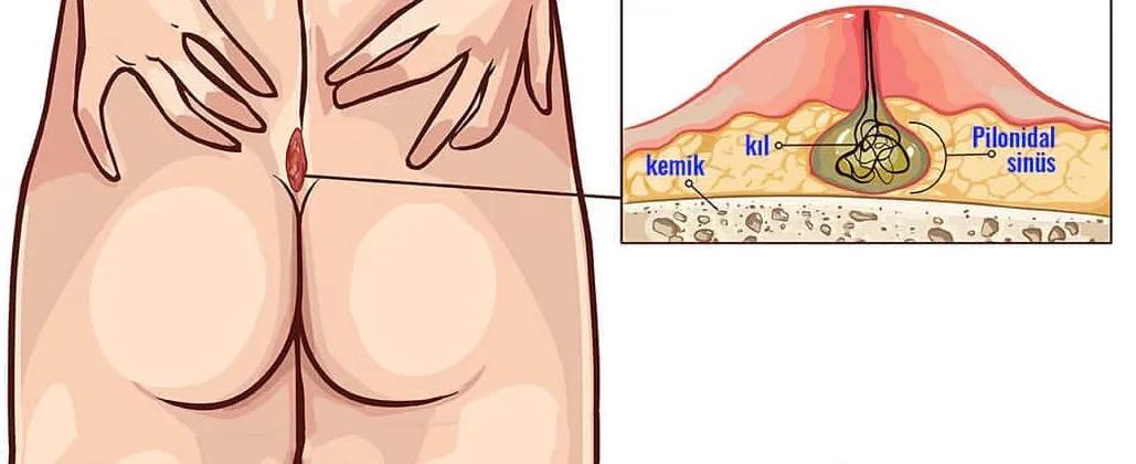 屁屁上有毛球怎么回事,臀部长毛的原因是激素分泌旺盛吗