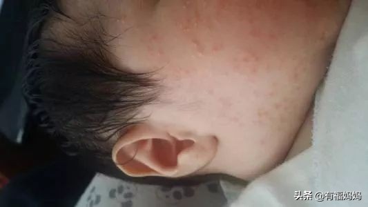 金牌月嫂对新生儿湿疹怎么护理,婴儿湿疹贴心护理