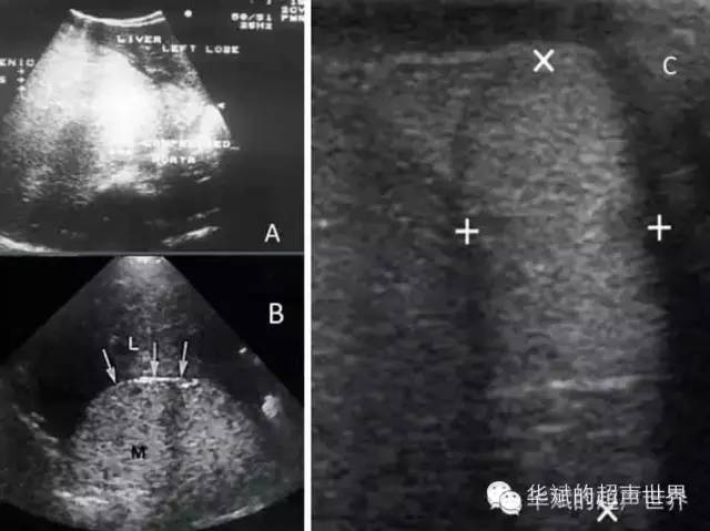纤维脂肪瘤属于什么类型的疾病,特殊类型脂肪瘤