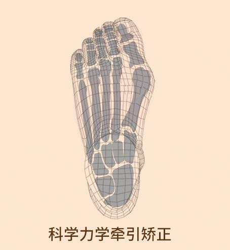 脚趾超级痛,轻度脚趾外翻如何矫正