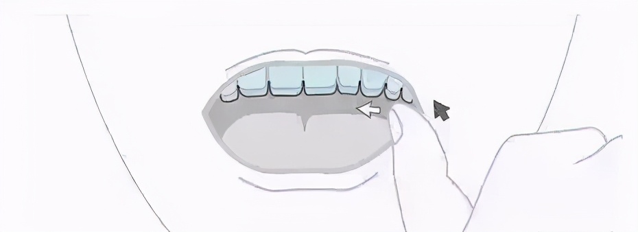 戴隐形牙套如何100分护理？