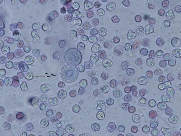 上皮细胞3+什么意思,上皮细胞阳性