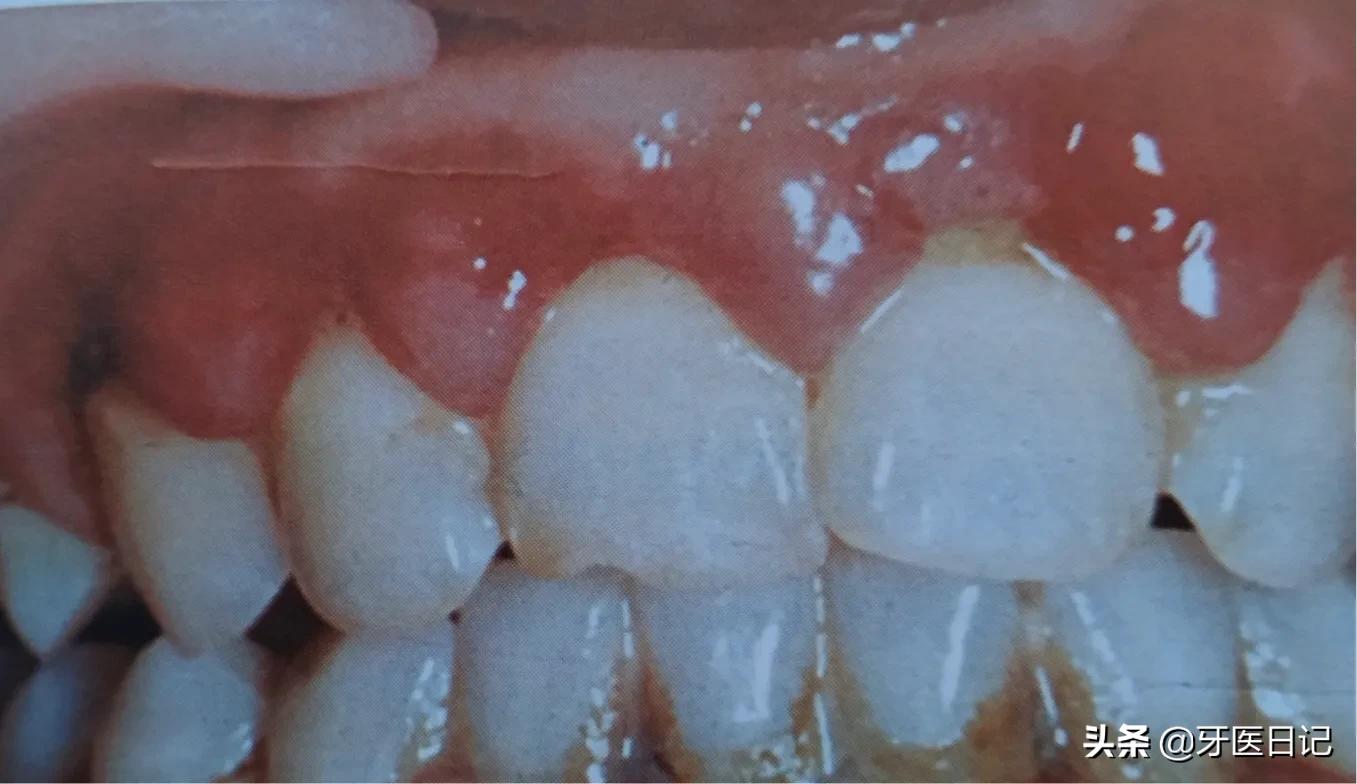 牙龈上火肿了吃什么药,牙龈肿了个肉坨上火疼