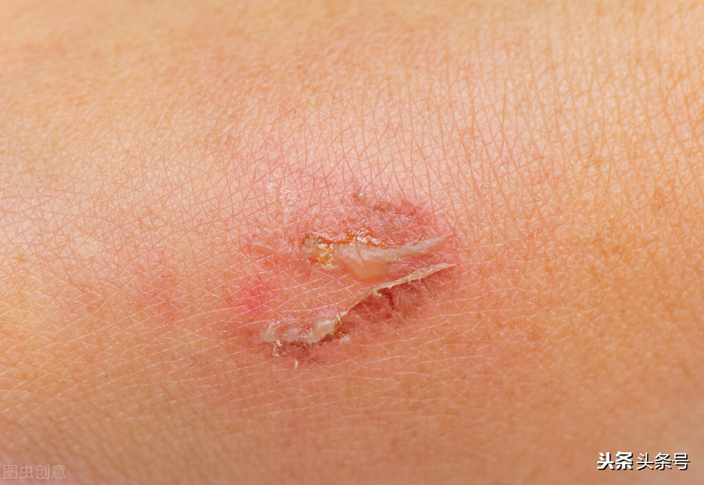 疤痕发红多久会淡化,疤痕发红用激光能不能消掉