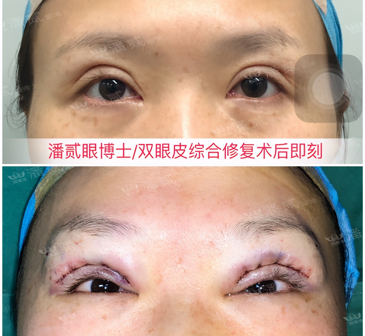 高难度修复双眼皮宽改窄恢复期,高难度双眼皮修复案例