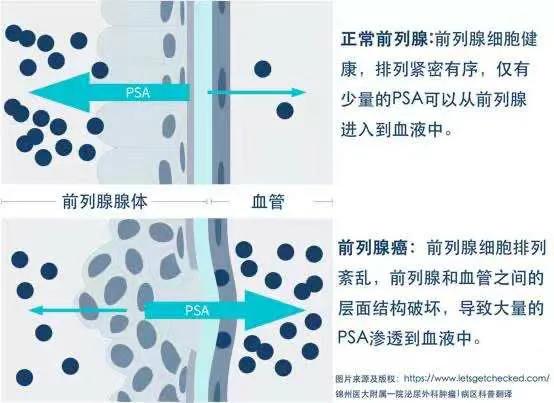 男人50岁检查哪几项,50岁男人psa早期症状