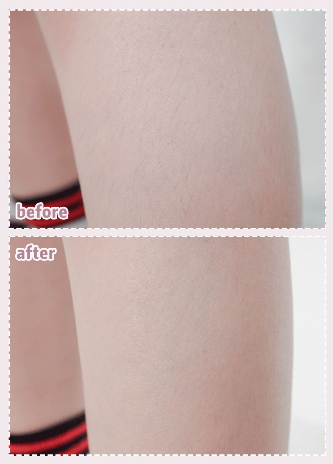 体毛脱毛的效果怎么样,天生体毛旺盛的人正常吗