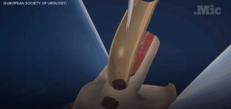 法国首例子宫移植成功,法国人移植子宫