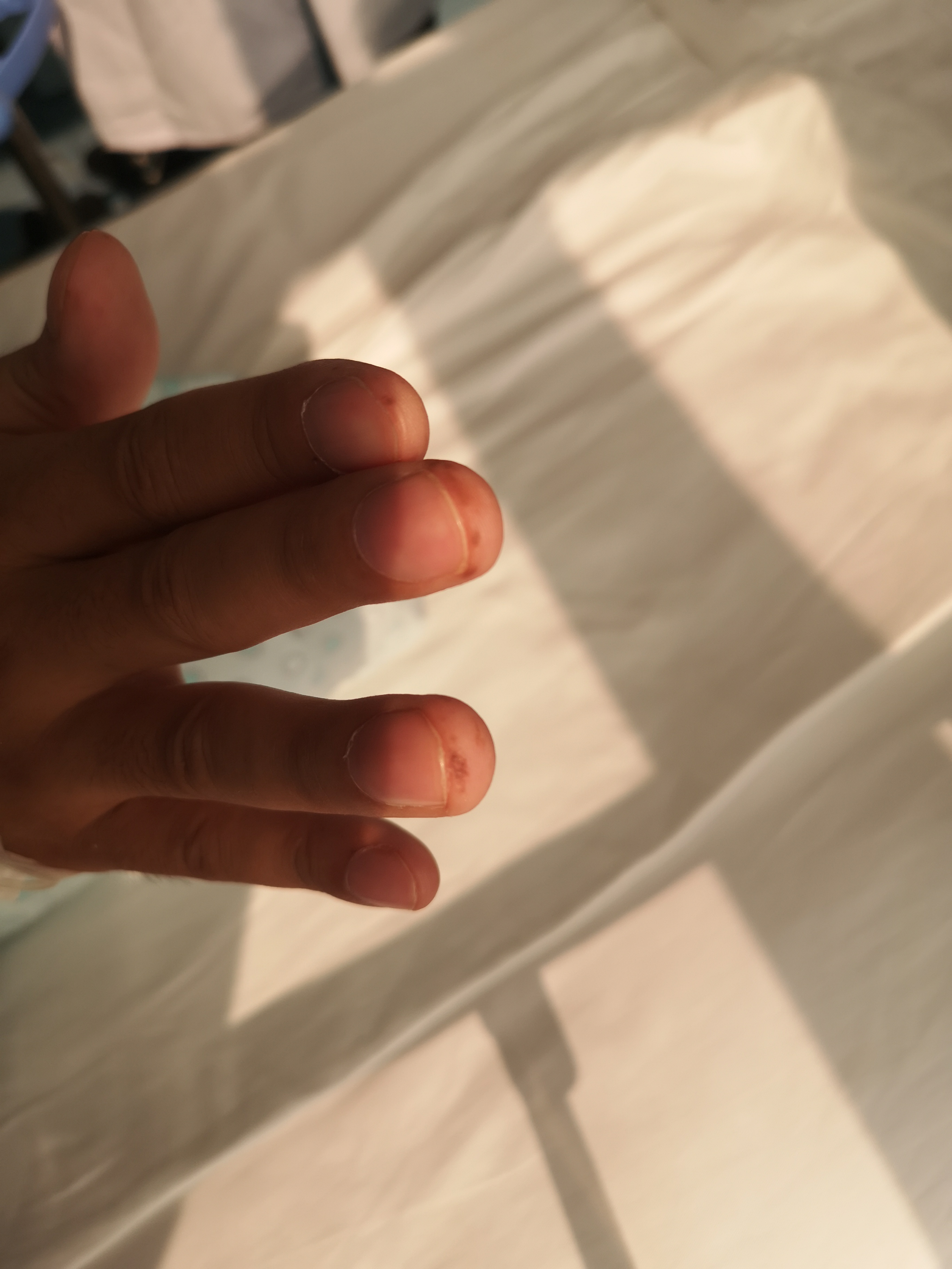 警惕这种黑痣可能是恶性肿瘤,这些地方有黑痣要注意了