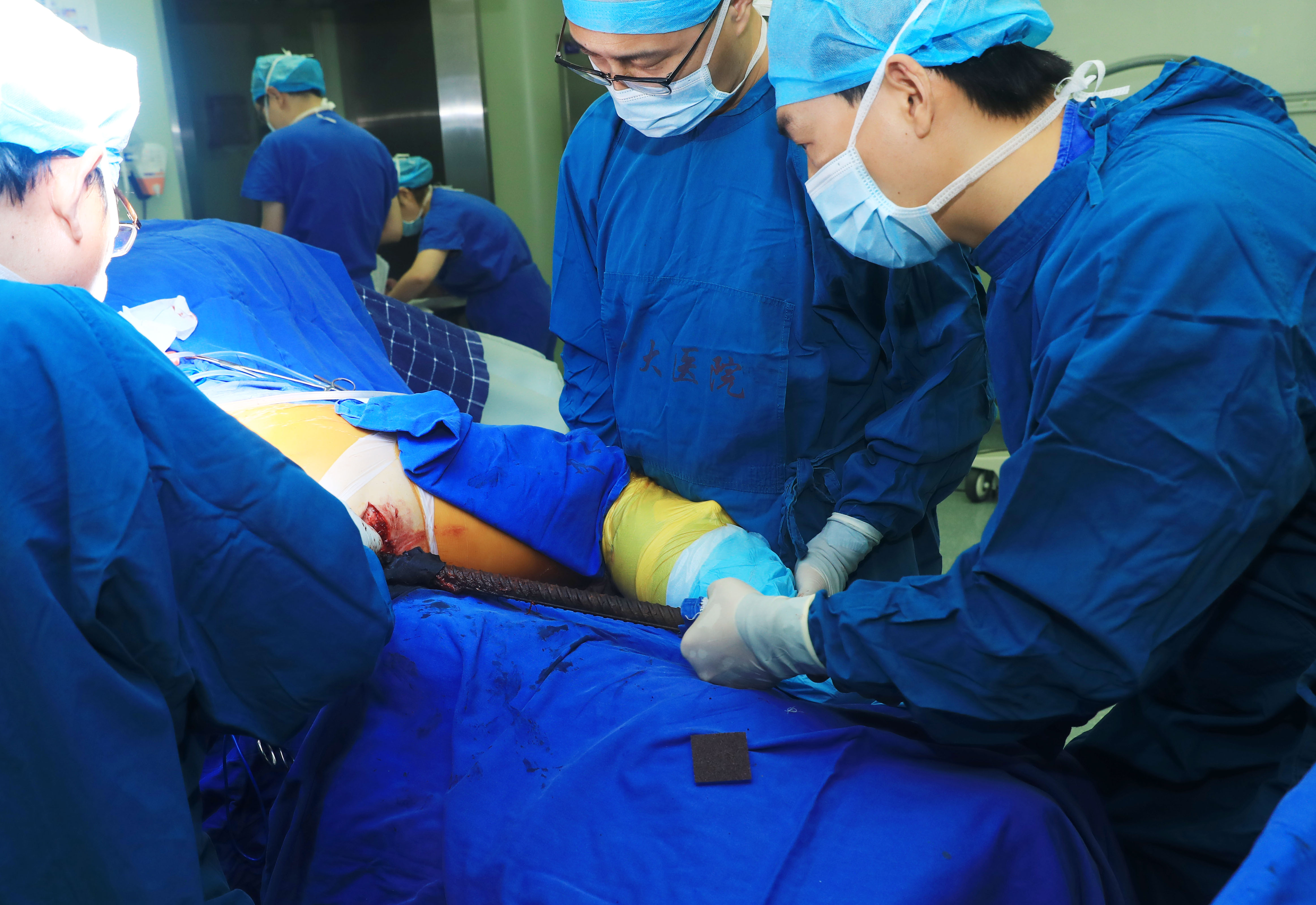 突发：90厘米长钢筋从会阴部插入穿腹入背结局：中大医院创伤中心多学科抢救化险为夷