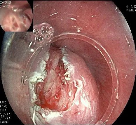 贲门隆起性病变影像,贲门溃疡隆起性病变