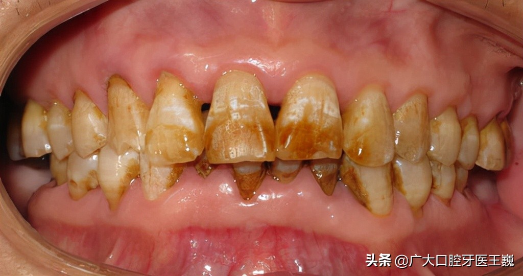 全瓷牙与烤瓷牙哪种好,好的烤瓷牙和便宜的全瓷牙的区别